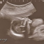 Baby-Update 20. SSW (19+3) II. Screening